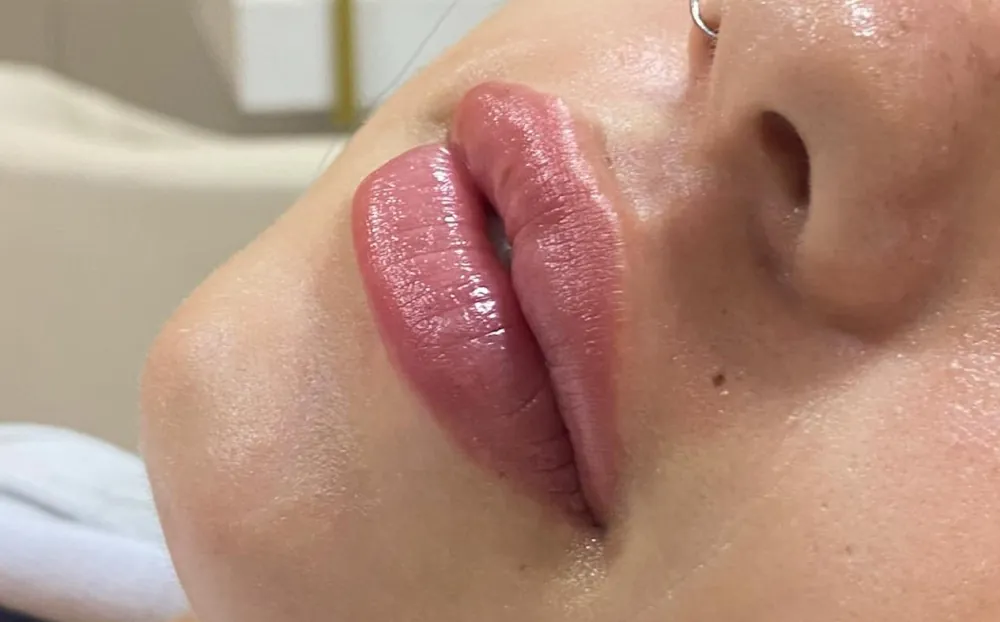Lábios após o preenchimento labial