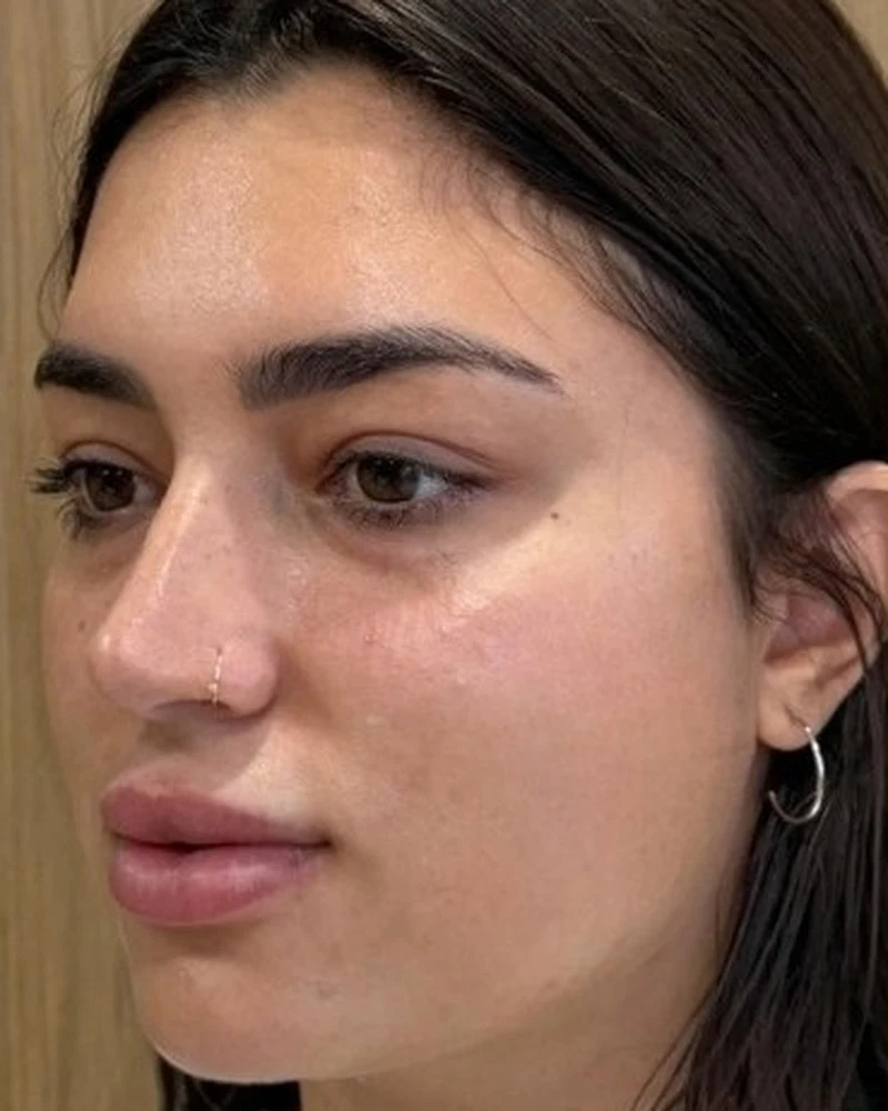 Rosto antes da harmonização facial