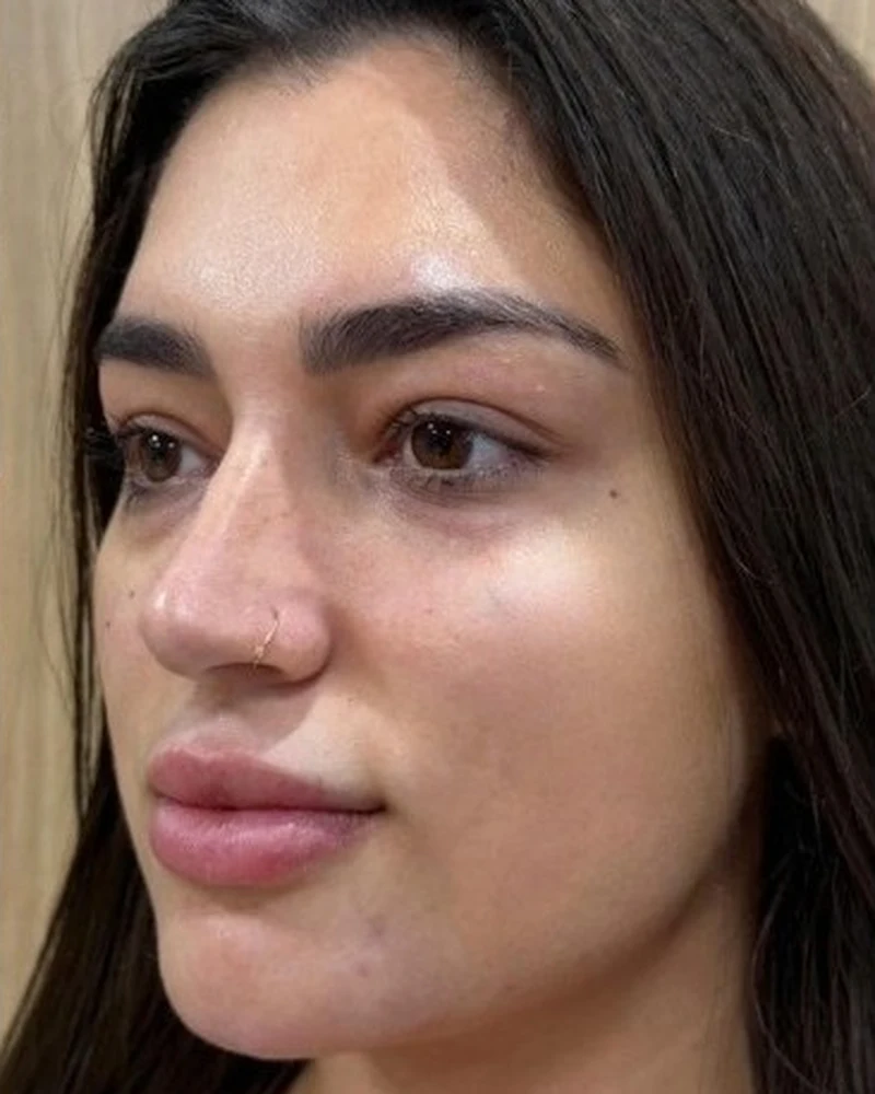 Rosto após a harmonização facial